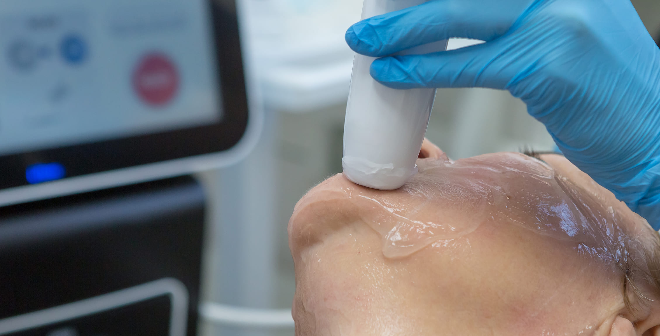 le traitement de l’alopécie à Montréal Peelings Chimiques à Montréal